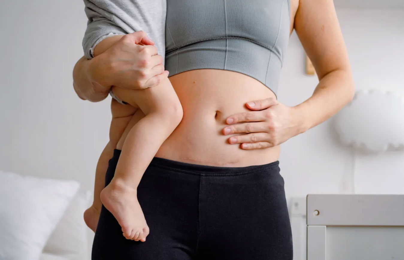 Diastasis recti: How to heal ab separation after pregnancy