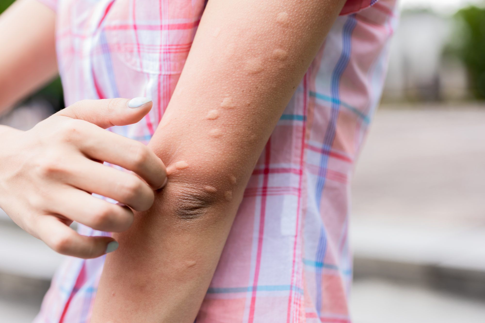 Hives: The Common and Surprising Causes - ER of Texas