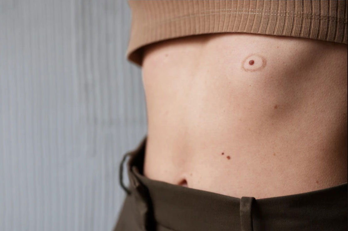 What Are the Warning Signs of Skin Cancer?