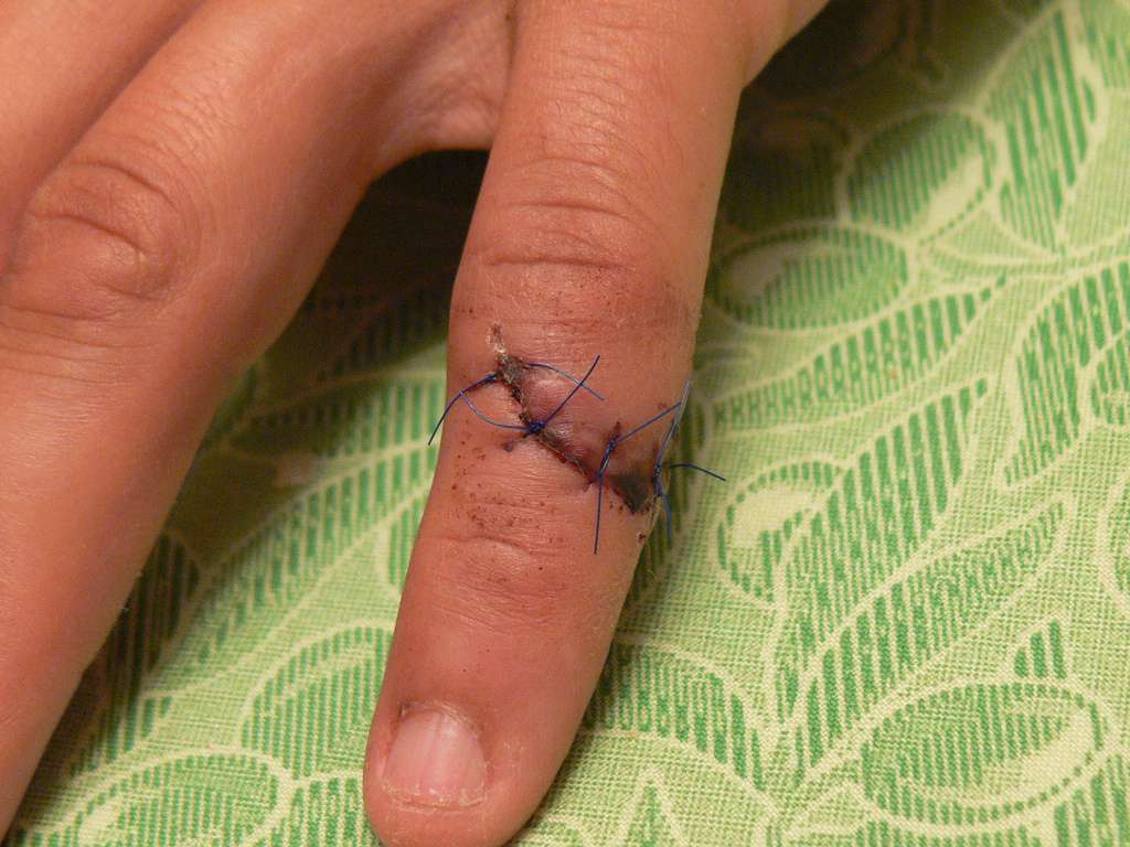 When Does a Cut Need Stitches? (for Parents) - Nemours KidsHealth